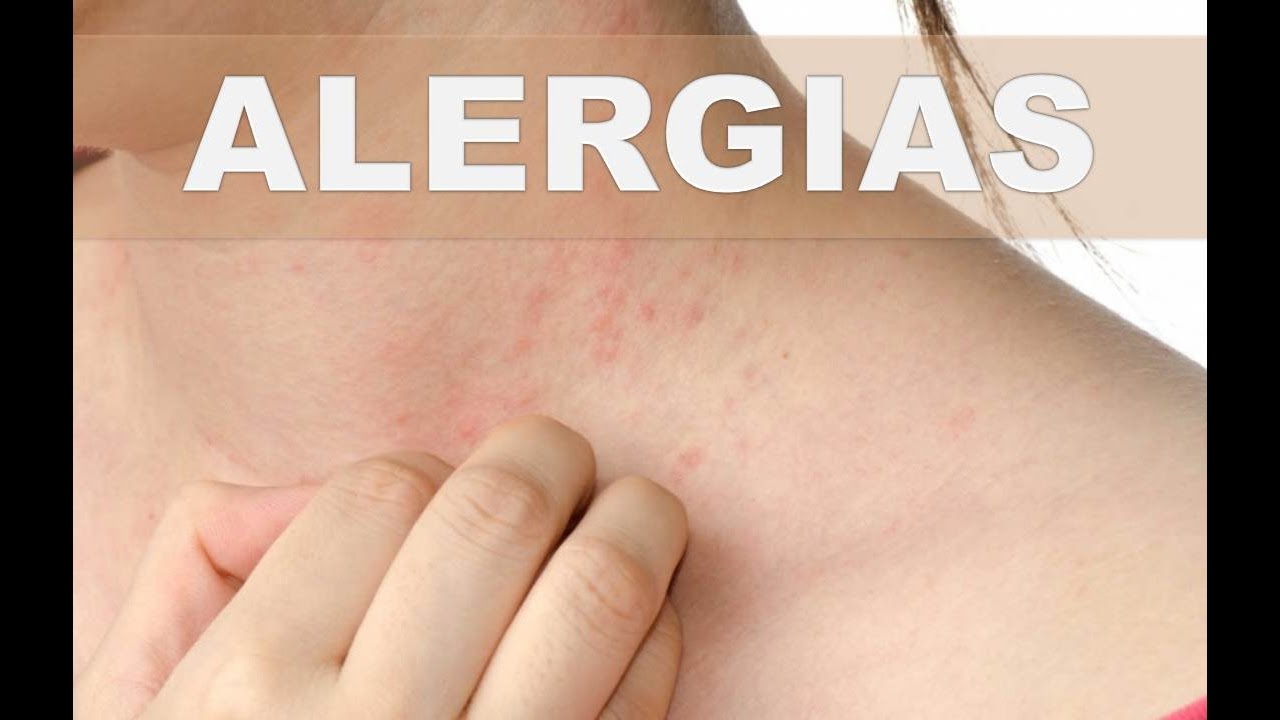 ☞ Remedios caseros para las alergias alimenticias – Como combatir la alergia a algunos alimentos