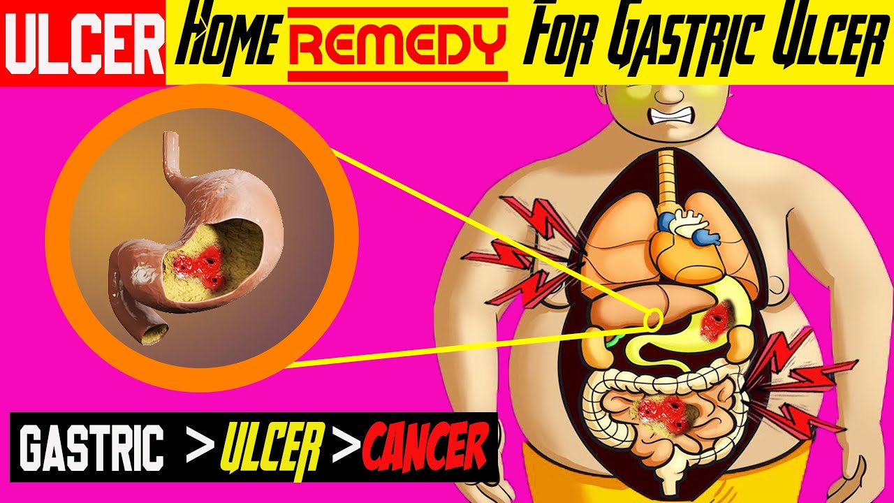 How Ulcer created And how to cure ulcer with simple Home remedy explained । Ted ed। Medical media