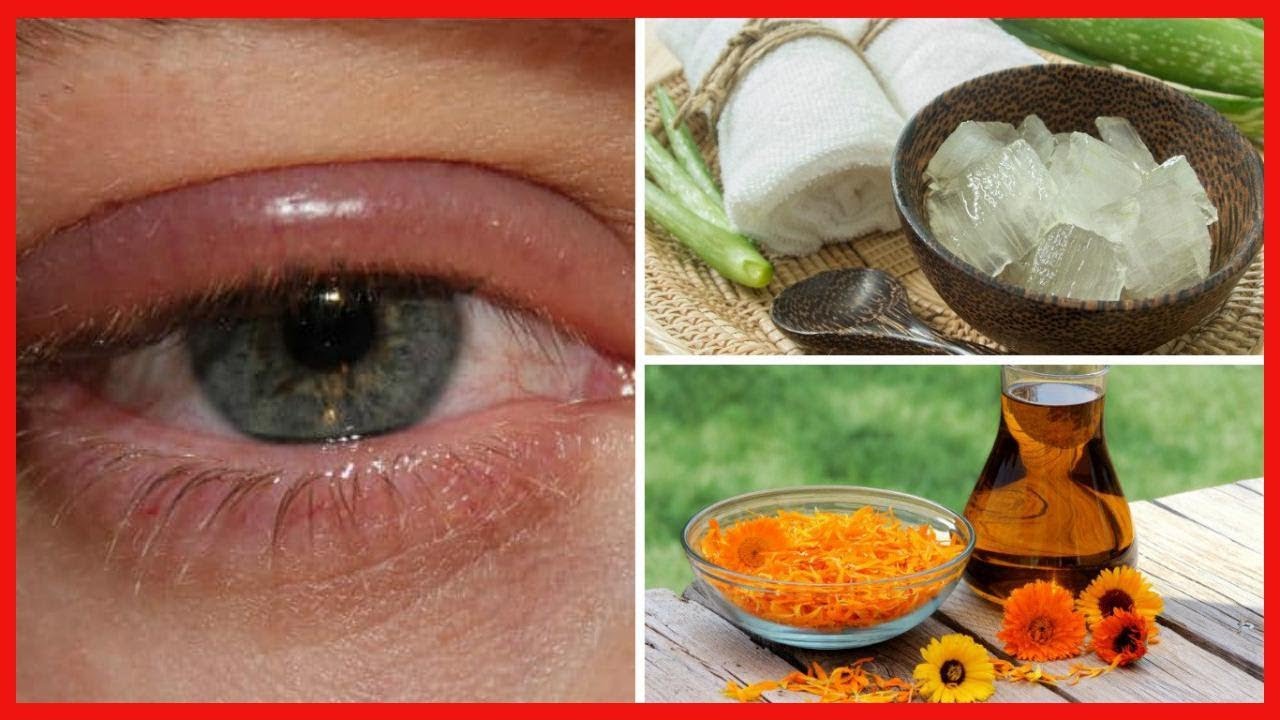 Combate las infecciones en los ojos con alguno de estos 8 remedios