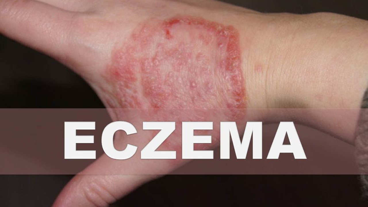 ☞ Remedios caseros para la eczema – Como aliviar la piel seca, escamosa e hinchada