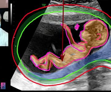 Die Mutter des Mädchens unterzieht sich einem Ultraschall um das Geschlecht des Babys herauszufinden